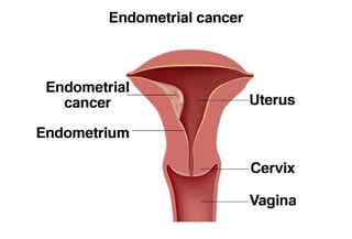 Endometrial-cancer.jpg