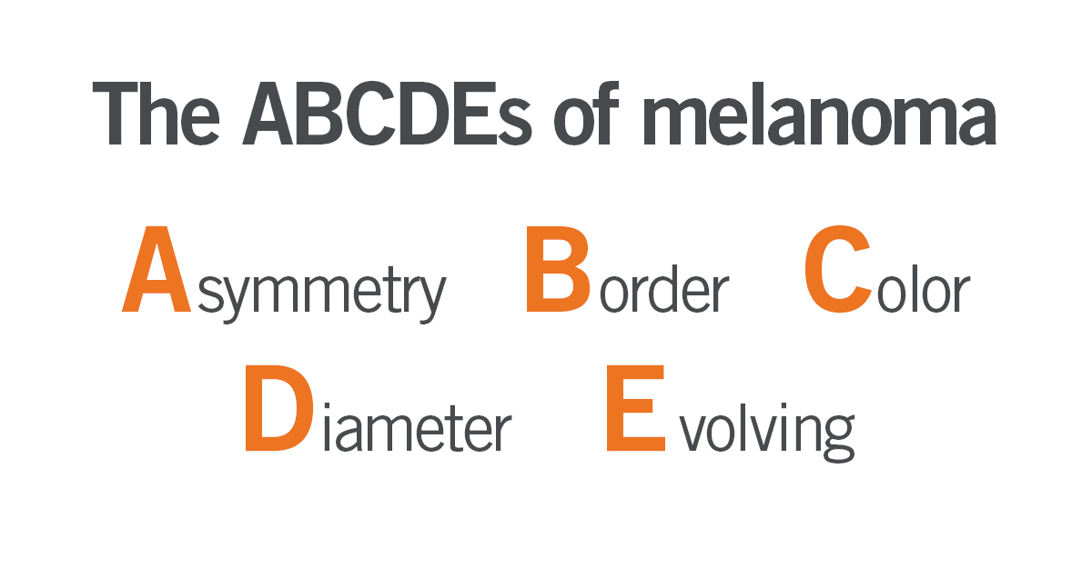 Know the signs of melanoma